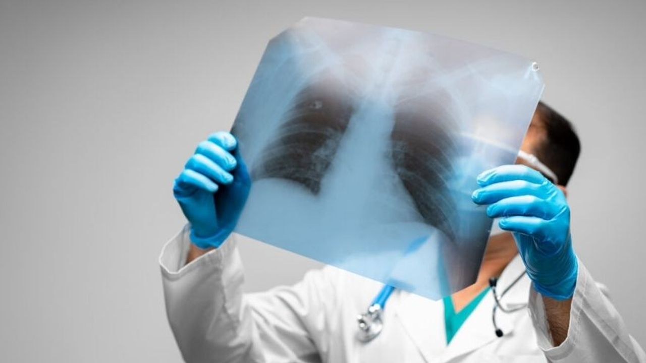 Akciğer Sönmesi (Pnömotoraks) Nedir? Belirtileri ve Tedavisi