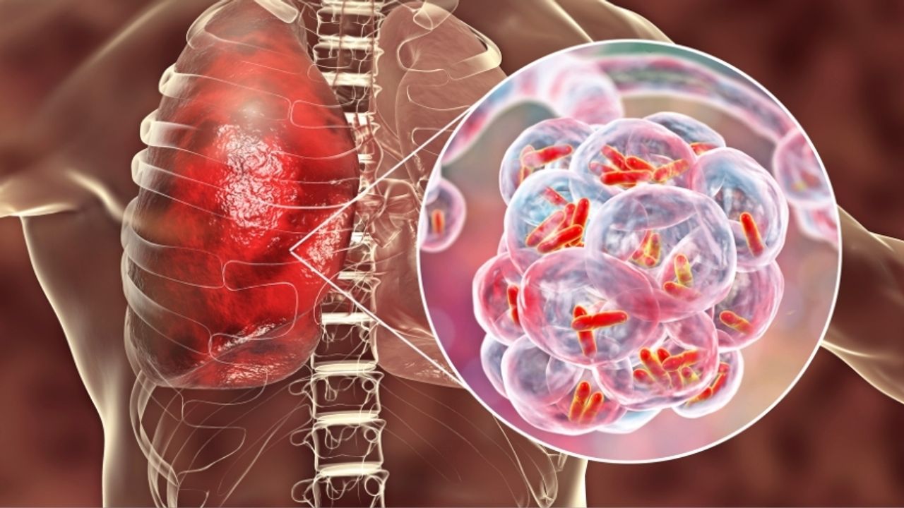 Zatürre Kanser Sinyali Verebilir: Uzmanlardan Kış Uyarısı