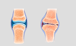 Osteoartrit (Kireçlenme) Nedir? Nasıl Tedavi Edilir?
