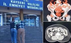 Kayseri'de Şüphelinin Midesi Uyuşturucu Deposu Çıktı