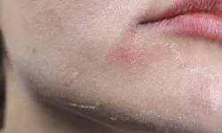 Cilt Kuruluğu Neden Olur?