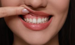 Diş Eti Kaşıntısının Sebebi Nedir?