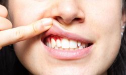 Diş Etleri Neden Kanar? C Vitamini Yanıt Olabilir