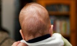 Kraniosinostoz Nedir? Belirtileri ve Tedavi Yöntemleri Nelerdir?