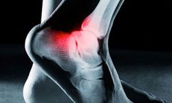 Pes Planus Nedir? Belirtileri ve Tedavi Yöntemleri