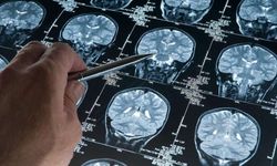 Alzheimer Teşhisinde Pratik ve Doğru Kan Testi
