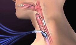 Trakeostomi Nedir ve Ne için Uygulanır?