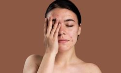 Molluscum Enfeksiyonu Nedir? Yaz Enfeksiyonlarına Dikkat!