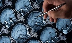 Alzheimer Riskinde Yeni Umut: Lityum