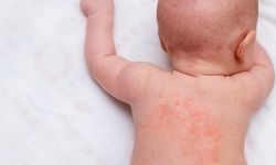 Bebeklerde İsilik Nasıl Geçer? Belirtileri ve Tedavi Yöntemleri