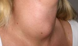 Cushing Sendromu Nedir? Belirtileri ve Tedavisi