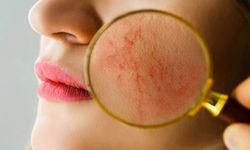 Kelebek Hastalığı (Lupus) Nedir? Belirtileri ve Tedavisi