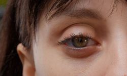 Myastenia Gravis Nedir? Belirtileri ve Tedavisi