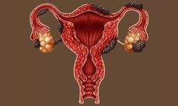 Çikolata Kisti Nedir? Belirtileri ve Tedavi Yöntemleri