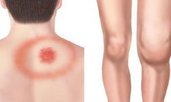 Lyme Hastalığı Hakkında Bilmeniz Gerekenler: Uzman Yanıtladı