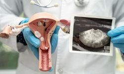 Polikistik Over Sendromu (PCOS) Nedir? Belirtileri ve Tedavisi