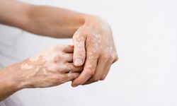 Vitiligo Nedir? Belirtileri ve Tedavi Yöntemleri