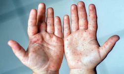 El, Ayak ve Ağız Hastalığı Nedir? Belirtileri ve Tedavi Yöntemleri