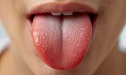 Dildeki Renk ve Çatlaklara Dikkat: Uzmanlar Uyardı