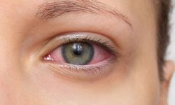 Göz Kanlanması Neden Olur ve Nasıl Geçer?