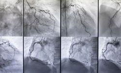 Koroner Anjiyografi Nedir? Tedavi Sürecine Etkisi