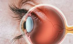 Retina Yırtığı Nedir? Nedenleri, Belirtileri ve Tedavisi