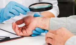 Stevens Johnson Sendromu Nedir? Nedenleri, Belirtileri ve Tedavisi