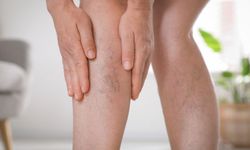 Venöz Yetmezlik Nedir? Belirtileri ve Tedavi Yolları