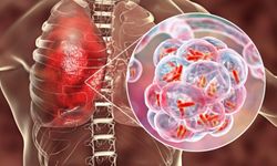 Zatürre Kanser Sinyali Verebilir: Uzmanlardan Kış Uyarısı