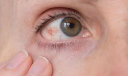 Göz Tansiyonu Nedir? Nedenleri, Belirtileri ve Tedavisi