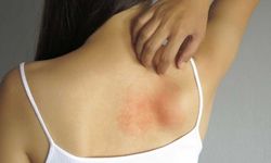 Histamin Nedir? Histamin İntoleransı Nasıl Ortaya Çıkar?