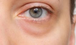 Ptozis Nedir? Nedenleri, Belirtileri ve Tedavisi