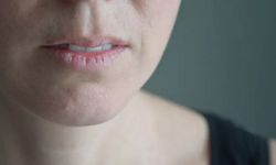 Sjögren Sendromu Nedir? Nedenleri, Belirtileri ve Tedavisi