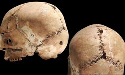10 Bin Yıl Önce Yapılan Beyin Ameliyatı Bilim Dünyasını Şaşırttı