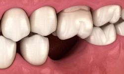 Yetişkinlikte Kaybedilen Dişlerin Yerine Neden Yenisi Çıkmıyor?