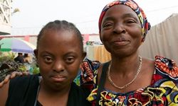 Siyahi Down Sendromlu Bireyler Neden Daha Az Görünüyor?