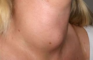 Cushing Sendromu Nedir? Belirtileri ve Tedavisi
