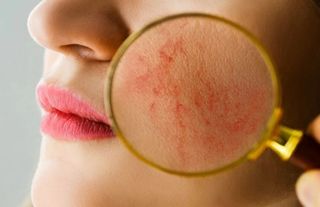 Kelebek Hastalığı (Lupus) Nedir? Belirtileri ve Tedavisi