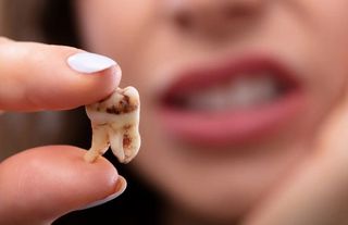 Tedavi Edilmeyen Diş Çürüğü Hangi Hastalıklara Yol Açar?