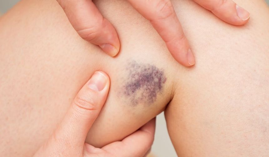 Darbe Sonrası Vücutta Oluşan Morluklar Neden Renk Değiştirir?