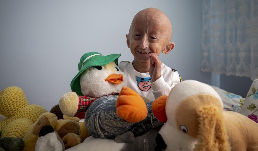 Erken Yaşlanma Hastalığı Progeria’nın Karanlık Yönleri Görsel 3