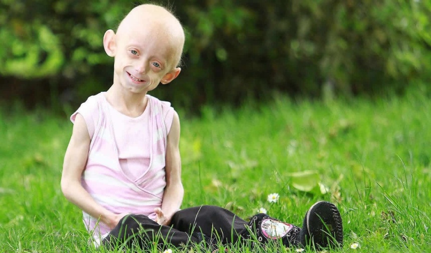 Erken Yaşlanma Hastalığı Progeria’nın Karanlık Yönleri Görsel 4