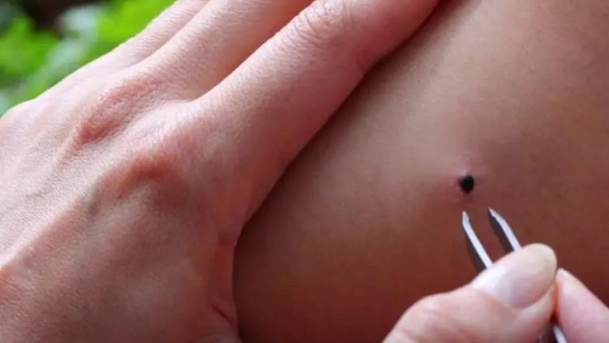Kene Isırması Nedir Belirtileri Ve Tedavi Süreci Nasıldır 2