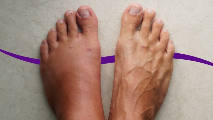 Ayak Şişliğine Ne İyi Gelir 3