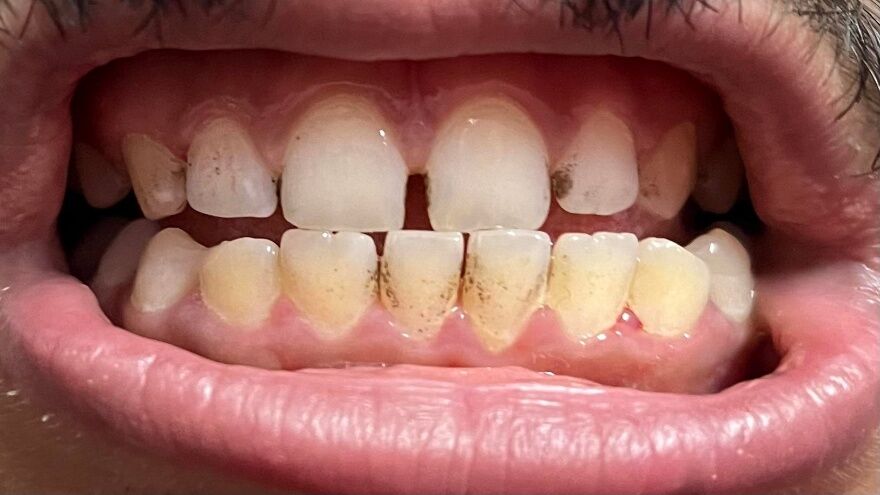 Dişlerdeki Siyah Lekeler Nasıl Çıkarılır 2