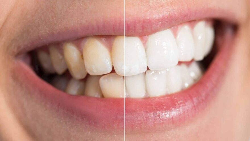 Dişlerdeki Siyah Lekeler Nasıl Çıkarılır