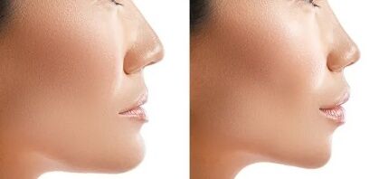 Mewing Yöntemi Yüz Şeklinizi Nasıl Değiştiriyor 3