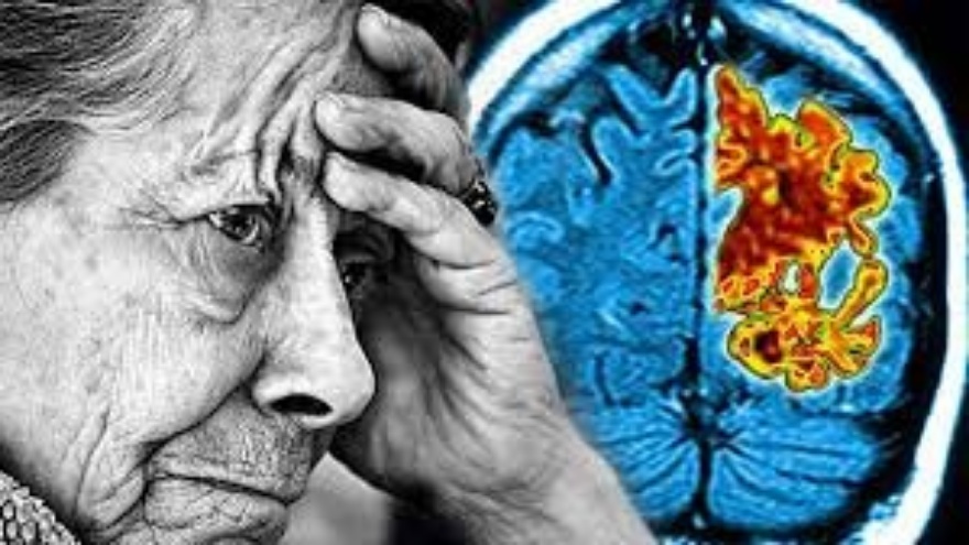 Alzheimer’da Lityum Azalması Hastalığı Tetikliyor