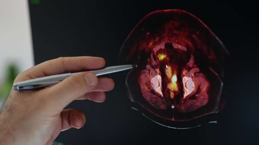 Kadınlarda Obezite Endometrium Kanseri Tehlikesini Yükseltiyor2