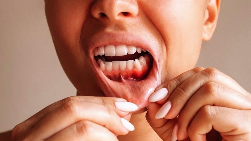 Diş Eti Apsesi Nedir Nedenleri Belirtileri Ve Tedavisi (2)